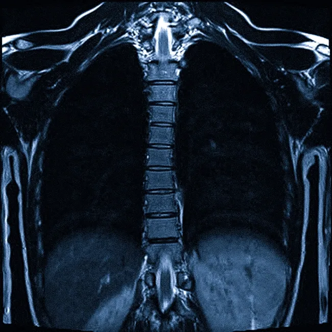 МРТ грудного отдела позвоночника