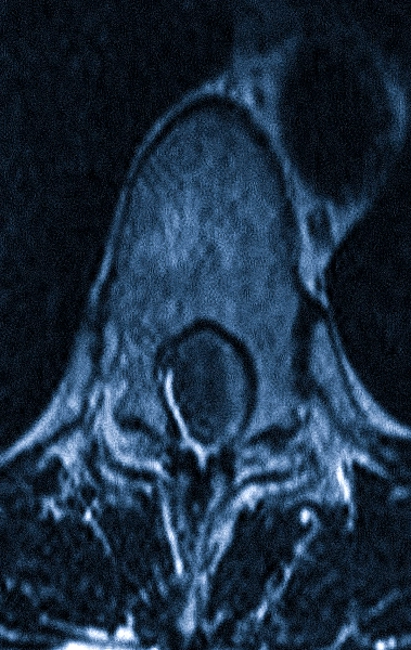 Менингиома на МРТ грудного отдела позвоночника