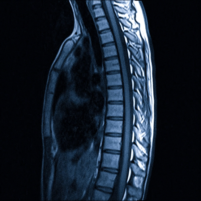 МРТ грудного отдела позвоночника