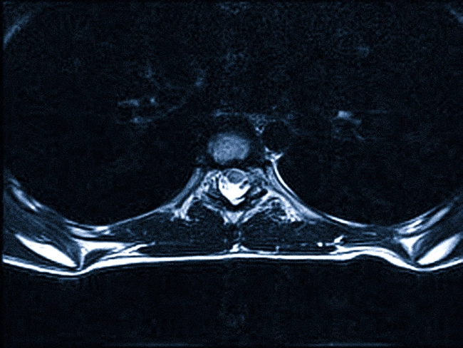 МРТ грудного отдела позвоночника