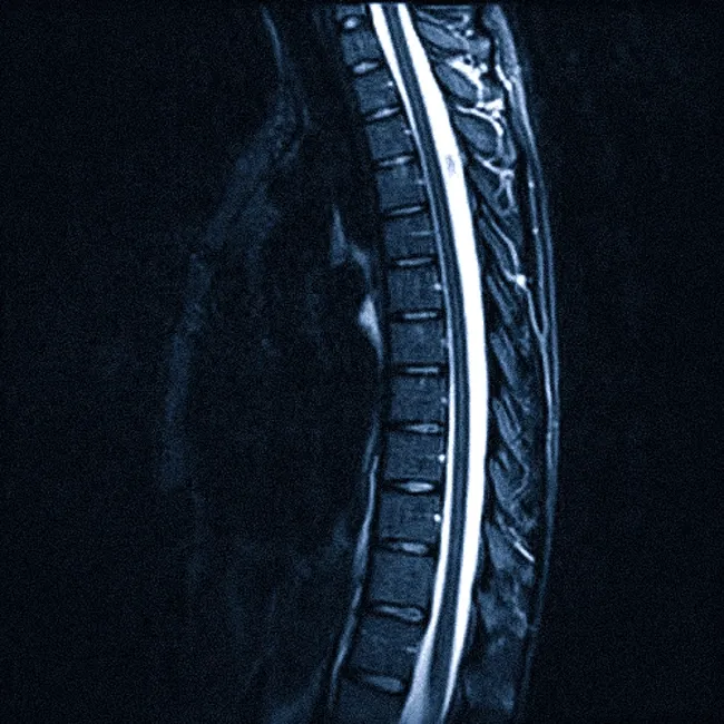 МРТ грудного отдела позвоночника что показывает