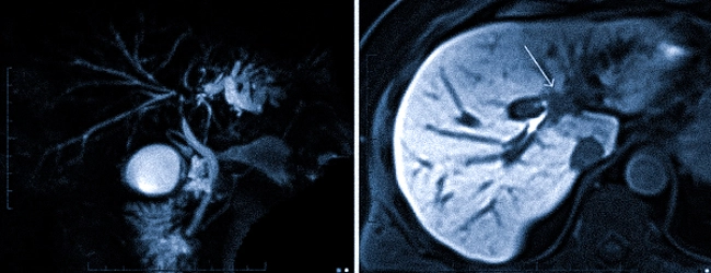 Опухоль Клацкина на снимках МР-холангиографии