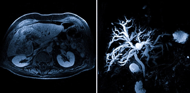 Холангиокарцинома на снимках МРТ