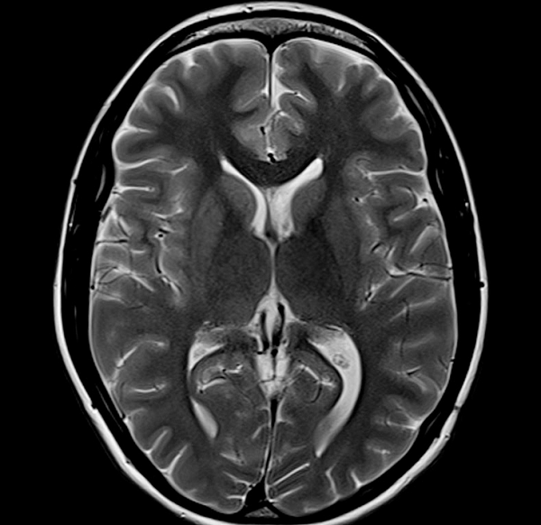 Снимок МРТ головного мозга в аксиальной проекции