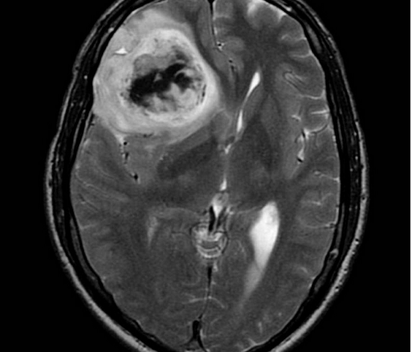 Олигодендроглиома головного мозга на МРТ