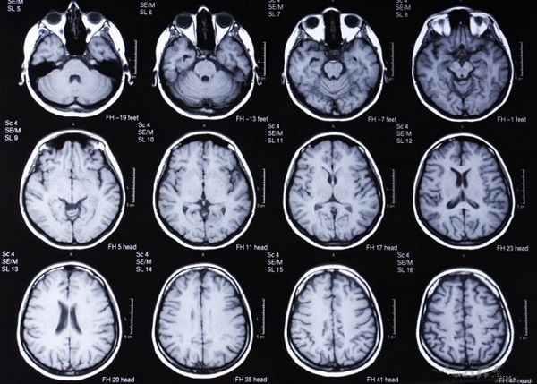 Магнитно-резонансное исследование новообразований головного мозга