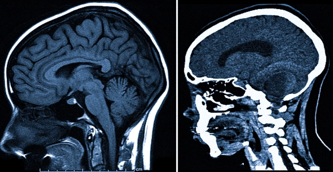 МРТ и КТ головы