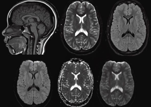 МР-сканы головы: сагиттальная и аксиальная проекци
