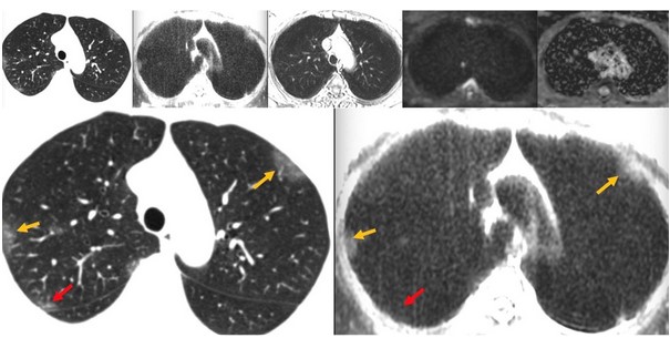 Снимки легких, полученные при КТ и МРТ у одного пациента с диагностированной пневмонией, вызванной вирусом SARS-CoV-2