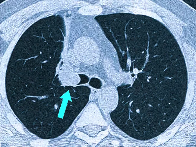 Центральный рак легкого на КТ-снимке (стрелка)