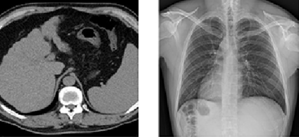  Слева - КТ, справа - рентгенография легких