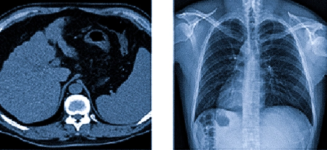  Слева - КТ, справа - рентгенография легких