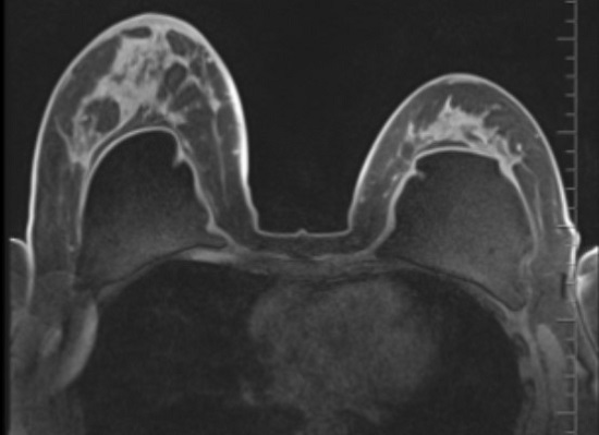 МР-сканирование груди с контрастом