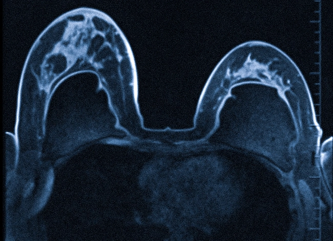 МР-сканирование груди с контрастом