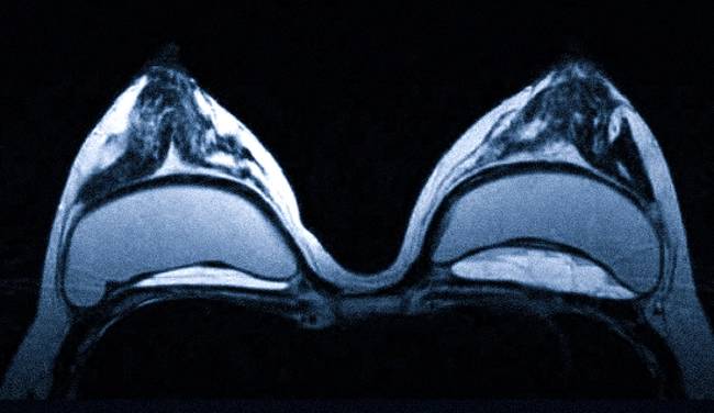 МРТ или маммография молочных желез