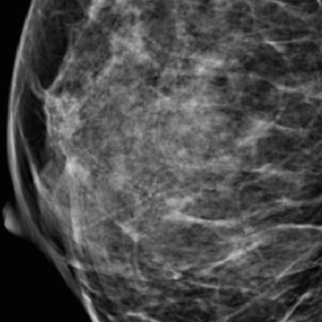 МРТ или маммография молочных желез