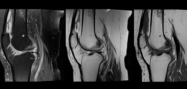 Синовит коленного сустава на МРТ