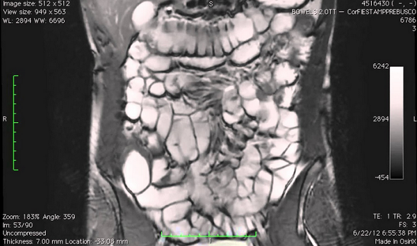 Снимок МРТ кишечника