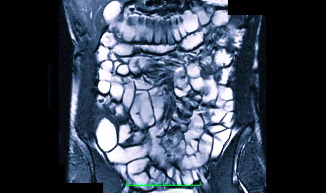 Снимок МРТ кишечника