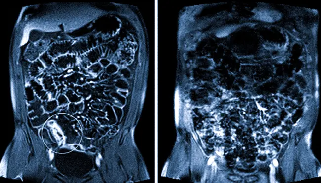 Болезнь Крона на снимке магнитно-резонансной томографии