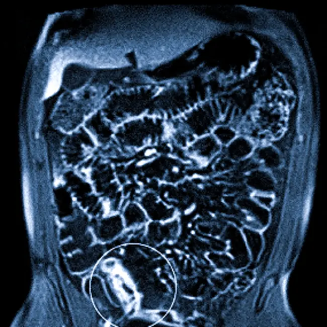 МРТ кишечника что показывает