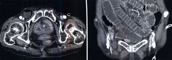 Снимки магнитно-резонансной томографии малого таза у женщин