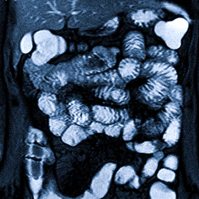 МРТ кишечника подготовка к исследованию