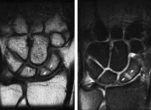 Перелом ладьевидной кости на МРТ