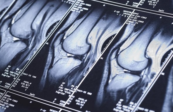 МРТ коленного сустава, что показывает