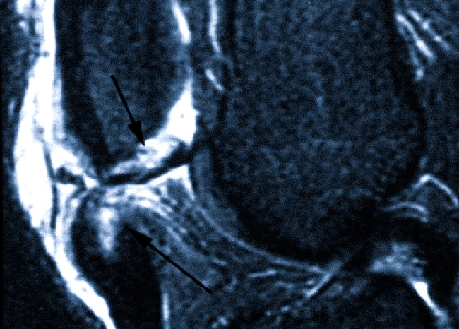 МРТ: перелом надколенника