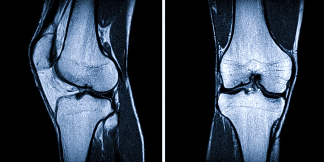 МРТ колена: гонартроз