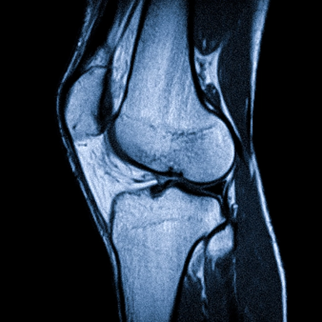 МРТ коленного сустава что показывает