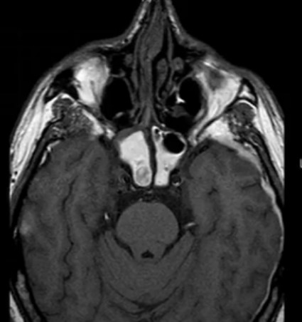 Гемосинус на МР-снимке головы