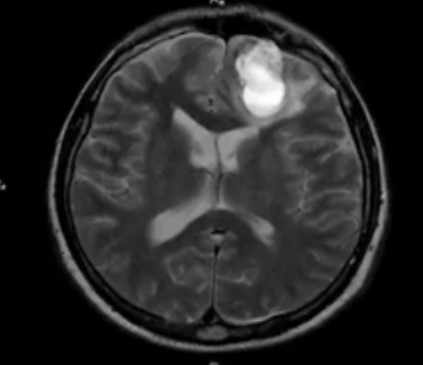 Внутримозговая гематома травматического характера на МР-снимке