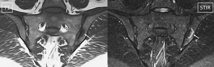МРТ: двусторонний склероз подвздошной кости с сужением суставной щели