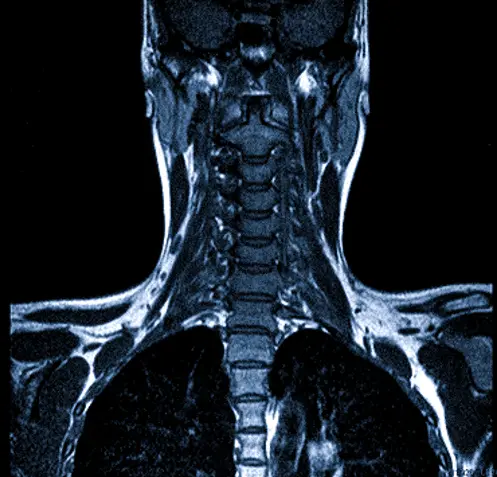 МРТ краниовертебрального перехода