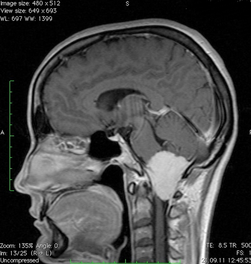 Менингиома краниовертебрального перехода на МРТ