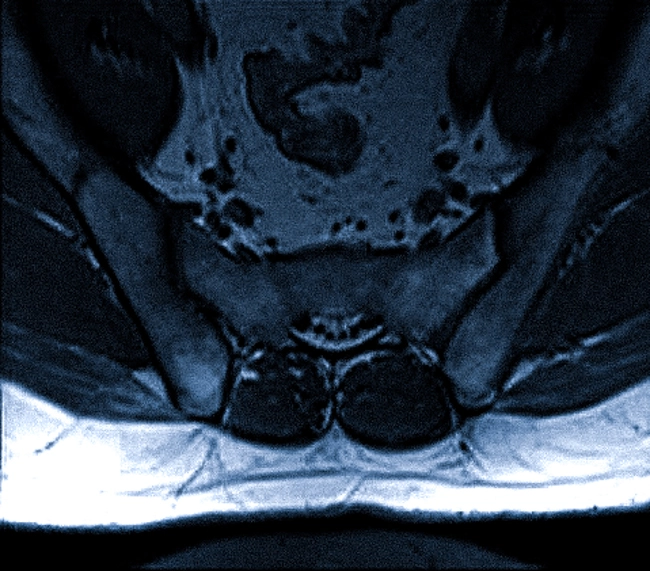 МРТ крестцово подвздошных сочленений