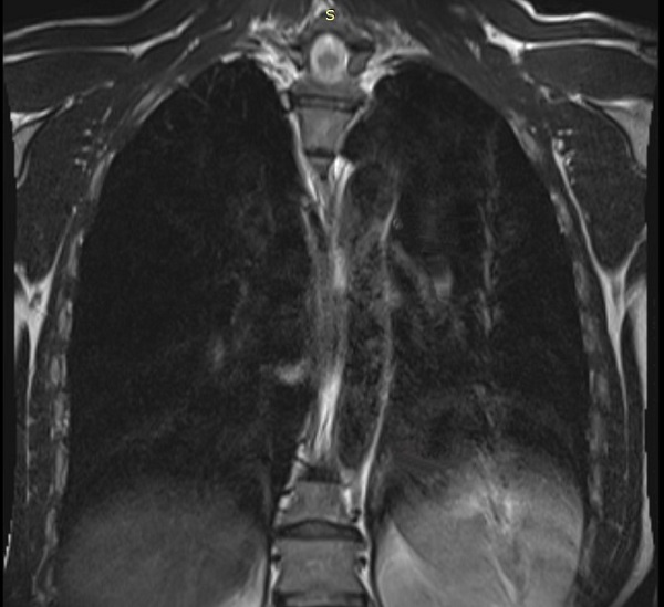 МРТ грудной клетки, фронтальная проекция