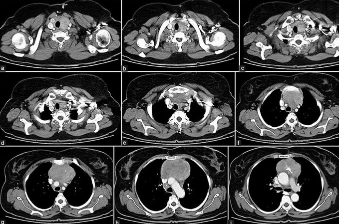 Серия послойных изображений МРТ грудной клетки