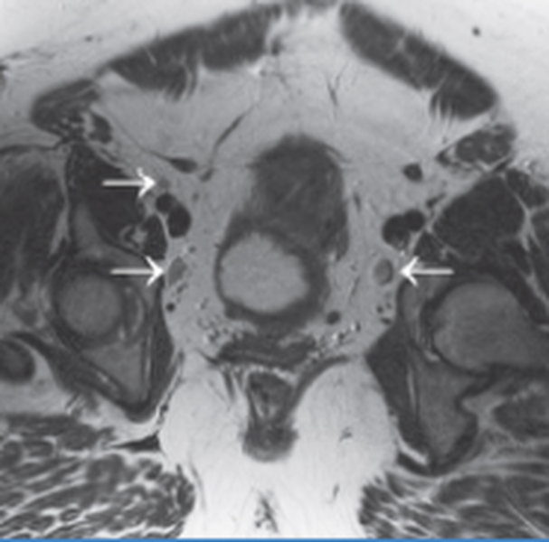 Лимфатические узлы малого таза на МРТ в норме