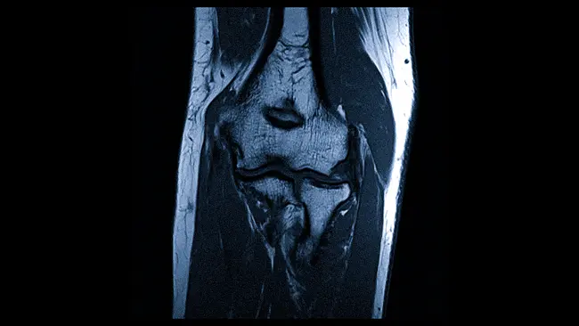 МРТ локтевого сустава