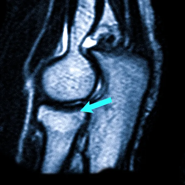 МРТ локтевого сустава что показывает