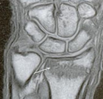 На фото МРТ: скрытый перелом, не обнаруженный с помощью рентгена