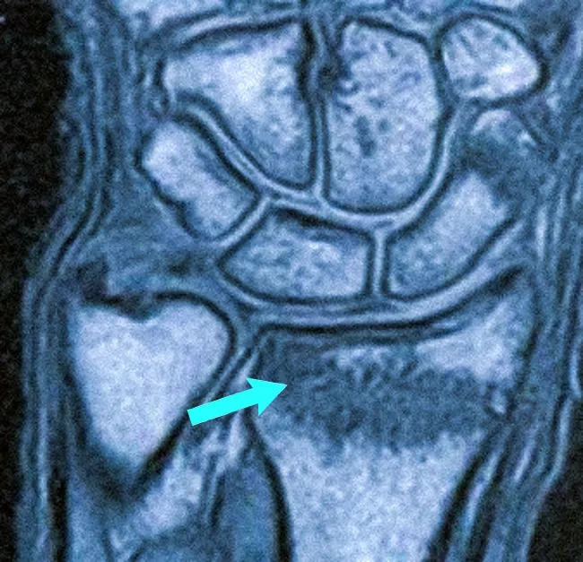 На фото МРТ: скрытый перелом, не обнаруженный с помощью рентгена