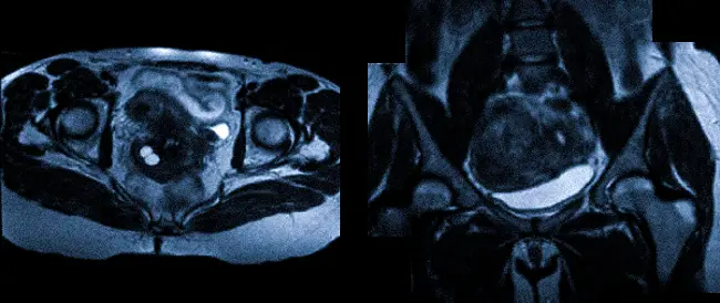 Органы малого таза на МР-изображениях