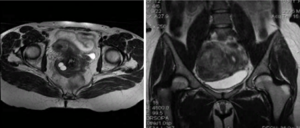 Магнитно-резонансная томография репродуктивных органов женщины