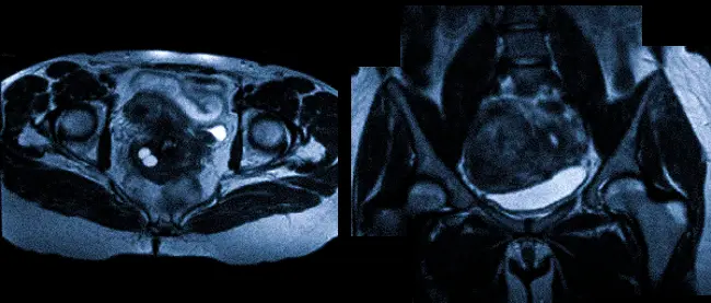 Магнитно-резонансная томография репродуктивных органов женщины
