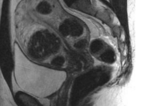   Магнитно-резонансное изображение множественной миомы матки