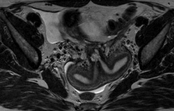 Двурогая матка на магнитно-резонансном скане 